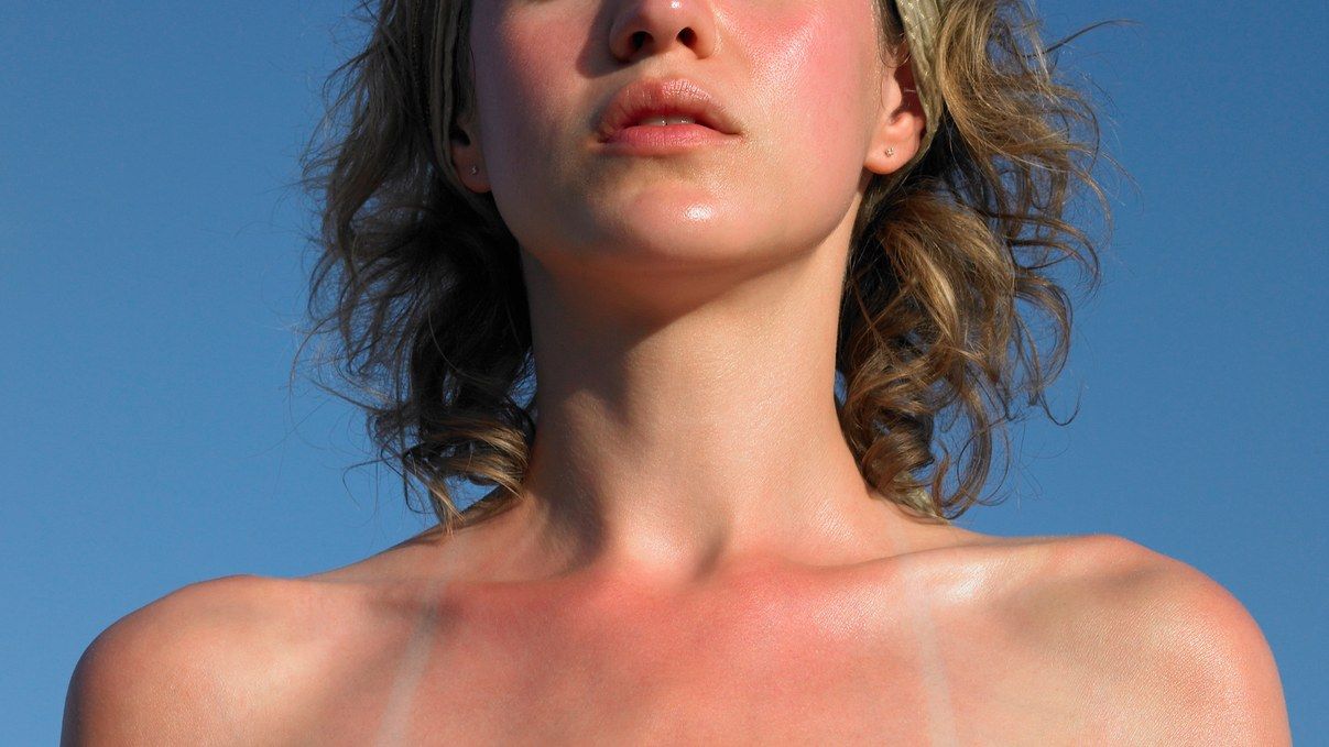 What to Do When Your Sunburn May Actually Be Sun Poisoning