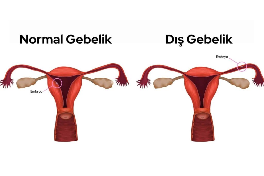 dis gebelik belirtileri nelerdir 1
