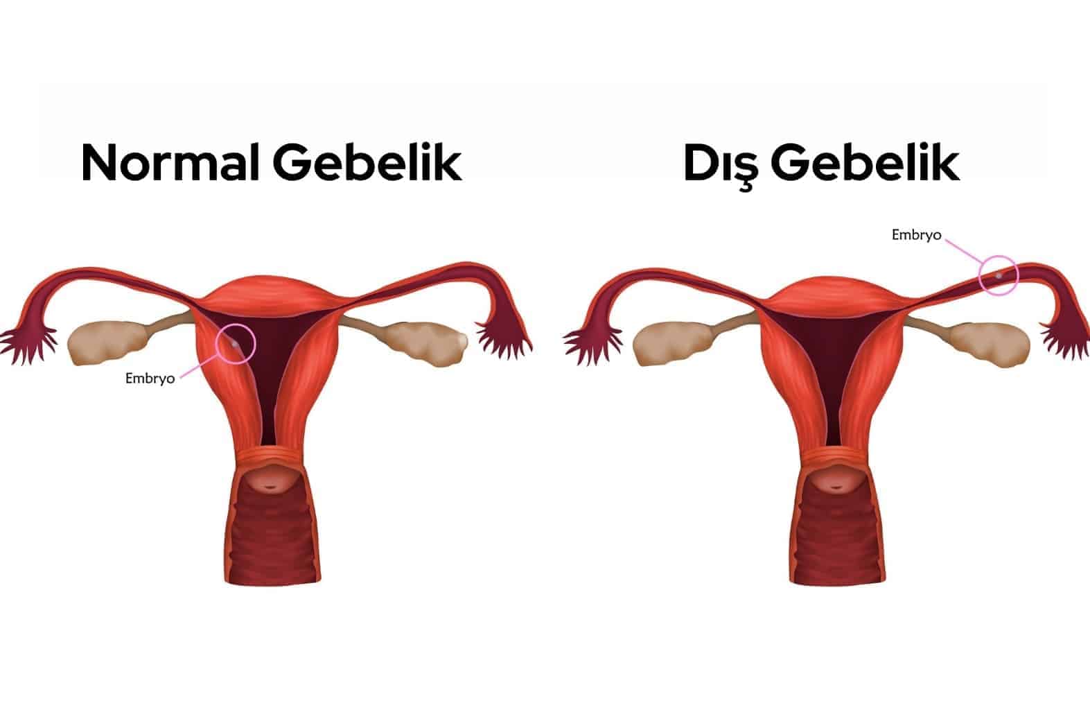 dis gebelik belirtileri nelerdir 1