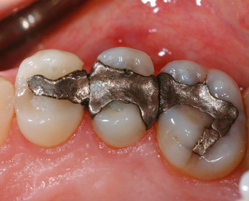 amalgam dolgu