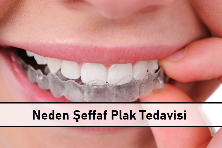 Neden şeffaf plak tedavisi